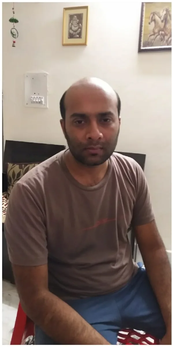 Before: client with crown hair loss