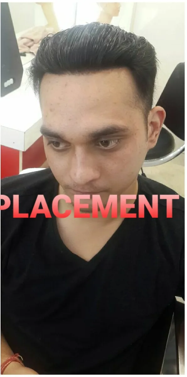 After: receding hairline restored with hair fixing