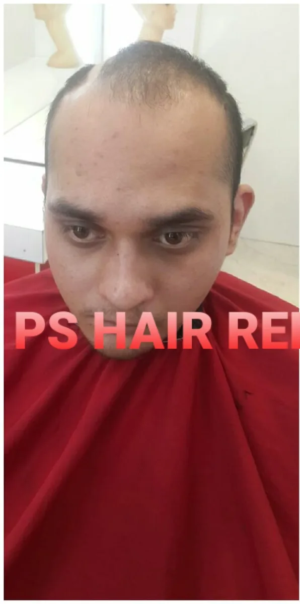 Before: client with hairline hair loss