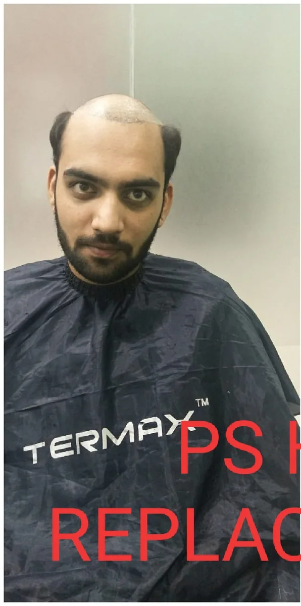 Before: client with full bald hair loss