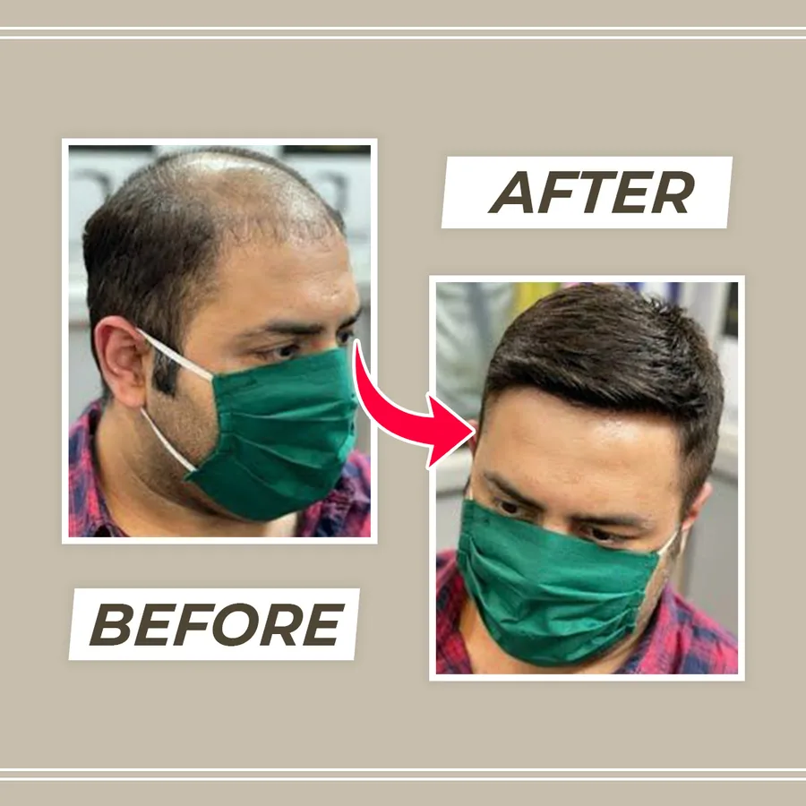 Before and after: crown baldness covered in one visit