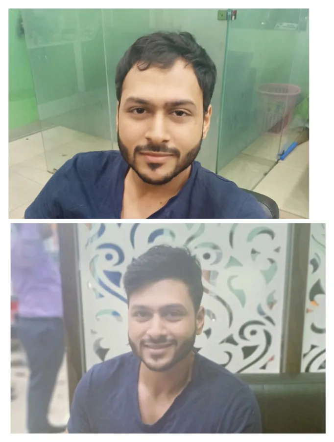 Before and after: natural front hairline
