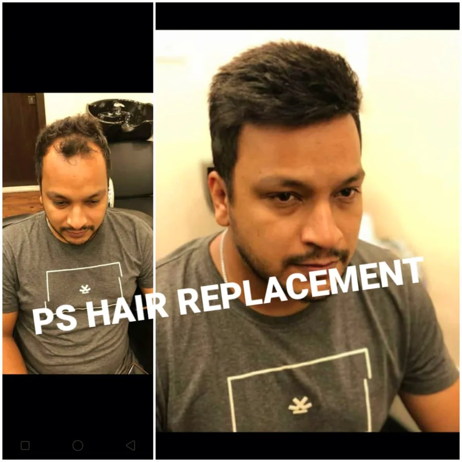 Before and after: full top coverage
