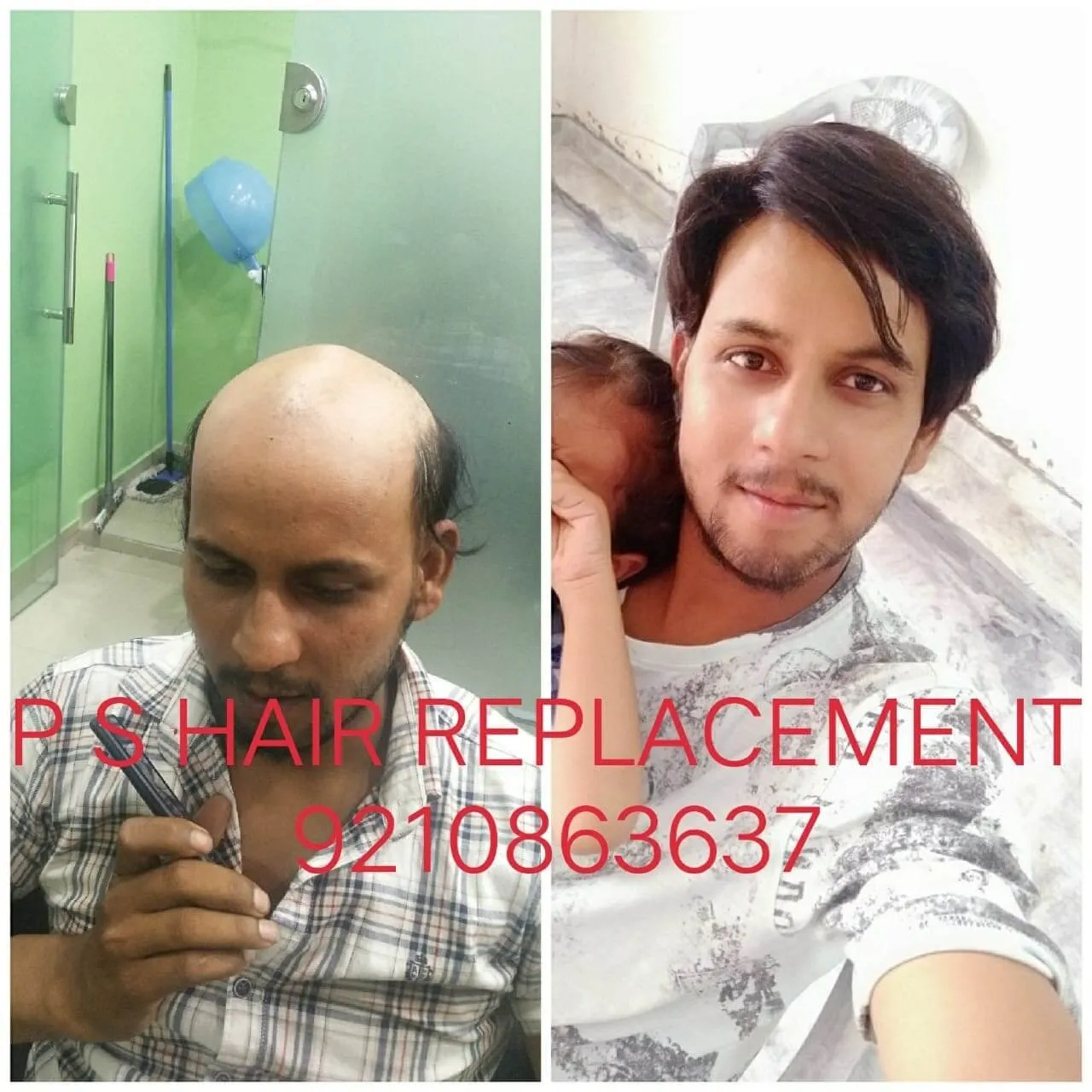 Hair Patch in Delhi  Hair Wigs Services